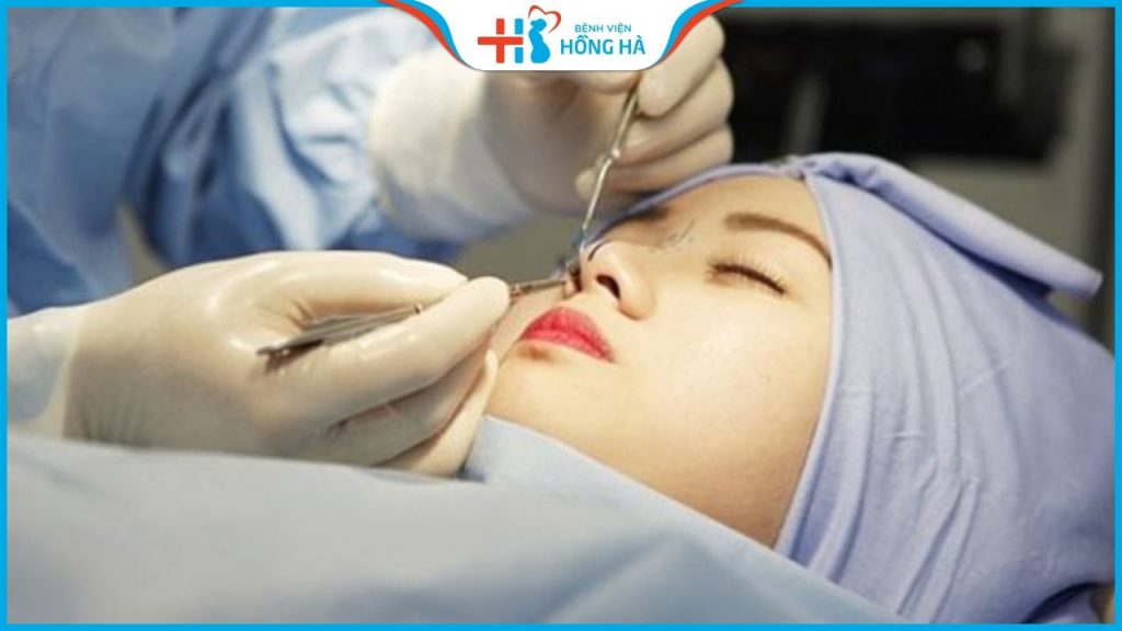 Tháo sụn mũi sau bao lâu thì lành? Chi phí? Nên tháo ở đâu?