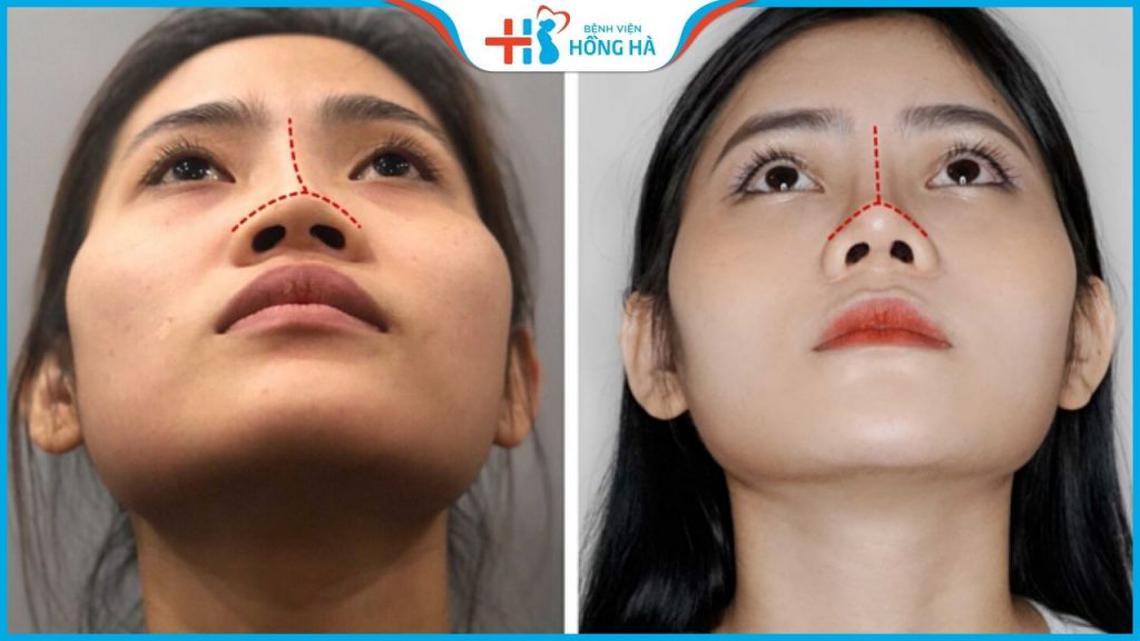 Tìm hiểu cặn kẽ các loại nâng mũi hiện nay trong ngành PTTM