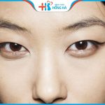 Mắt xếch là gì – 2 phương pháp cải thiện mắt xếch hiệu quả