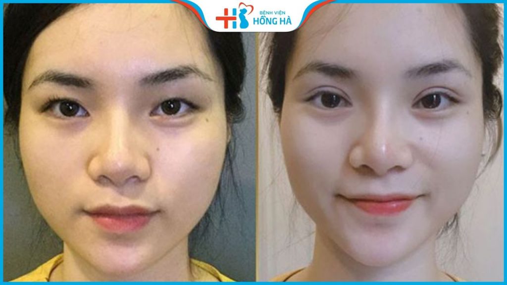 Cắt mí kiêng trứng bao lâu? Ngoài trứng cần kiêng những thực phẩm gì?