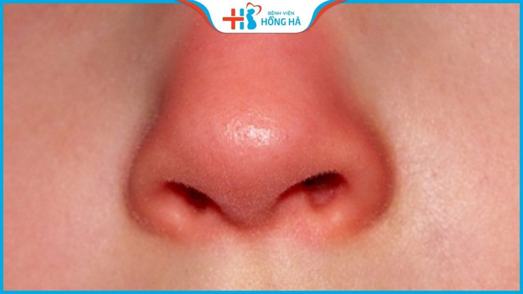 Mũi cà chua có nên sửa hay không? Giải đáp thắc mắc về mũi cà chua