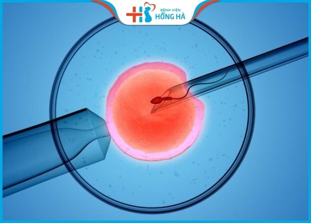 Chữa vô sinh nữ bằng thụ tinh ống nghiệm (IVF)
