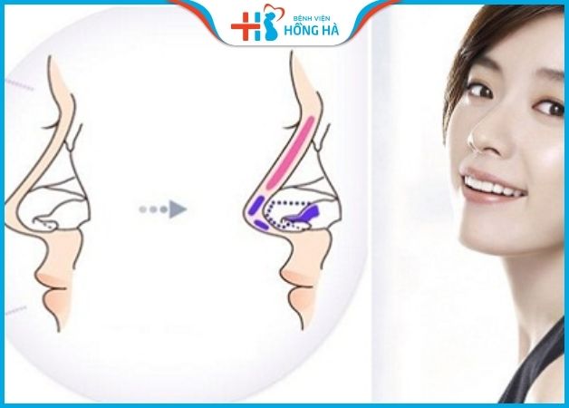 Nâng mũi bọc sụn khắc phục khuyết điểm lộ đầu mũi