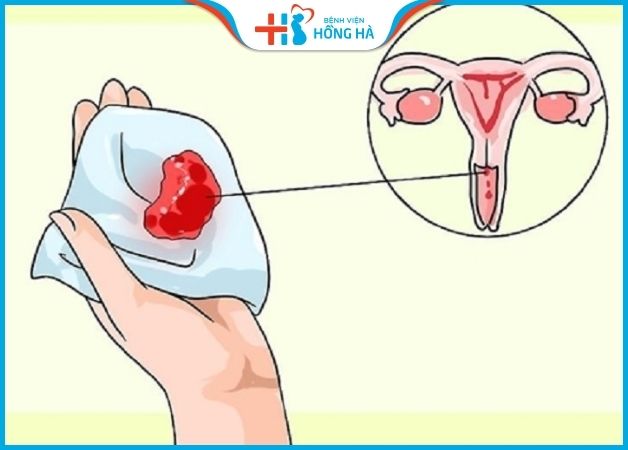 Chảy máu sau khi đặt vòng tránh thai