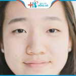 Mũi tẹt xấu hay đẹp? Tướng số của người sở hữu và cách khắc phục