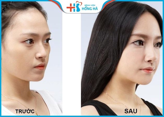 KH trước và sau tiêm filler mũi tại BV Hồng Hà