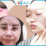 Cảnh báo: 5 biến chứng sau nâng mũi và cách phòng ngừa, xử lý đúng