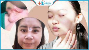 Cảnh báo: 5 biến chứng sau nâng mũi và cách phòng ngừa, xử lý đúng