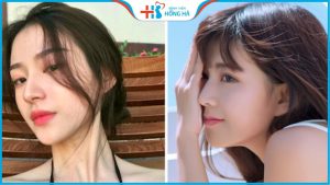 Các dáng mũi nâng đẹp được ưa chuộng nhất hiện nay