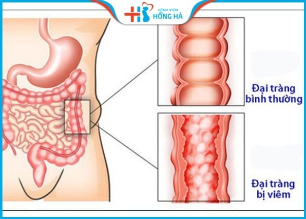 đau bụng dưới bên phải nữ là bệnh gì