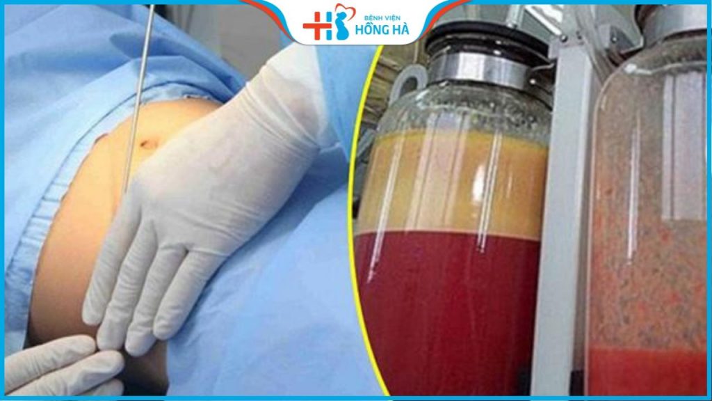 Hút mỡ tại bệnh viện Hồng Hà có tốt không? Có an toàn không?