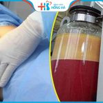 Hút mỡ tại bệnh viện Hồng Hà có tốt không? Có an toàn không? 