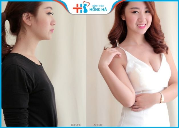 Tự tin diện váy xinh sau nâng ngực tại BV Hồng Hà - Nâng ngực bệnh viện hồng hà có tốt không