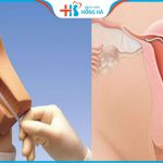 Những lưu ý khi đặt vòng tránh thai cần biết – BS sản khoa khuyến cáo