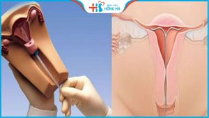 Những lưu ý khi đặt vòng tránh thai cần biết – BS sản khoa khuyến cáo