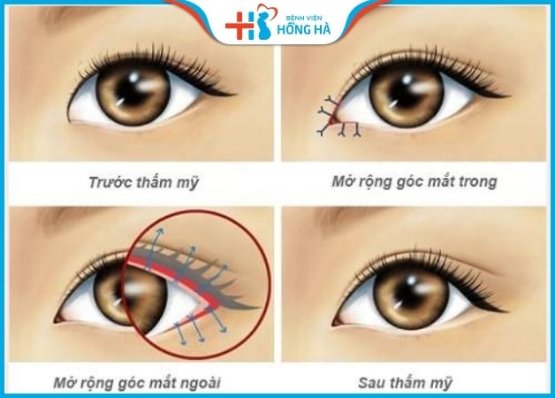 Cắt/ tạo khóe mắt trong, ngoài