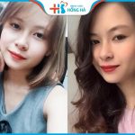 Bấm Mí Thái Lan: Sở hữu mắt đẹp hoàn hảo chỉ sau 30 phút nhấn mí