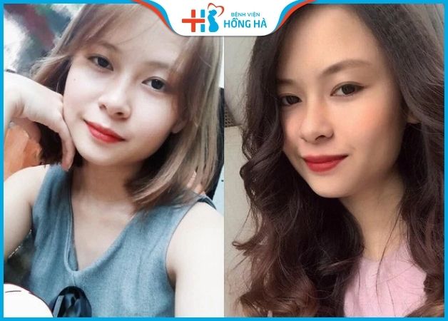 Bấm Mí Thái Lan: Sở hữu mắt đẹp hoàn hảo chỉ sau 30 phút nhấn mí