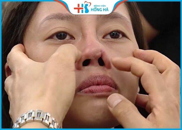 Biến chứng nâng mũi