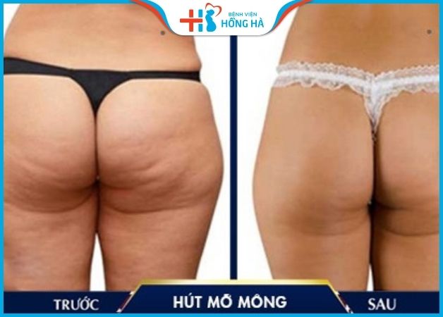 Hình ảnh trước và sau khi hút mỡ mông tại BV Hồng Hà