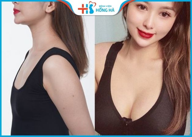 Hình ảnh trước và sau khi nâng ngực túi Motiva tại BV Hồng Hà