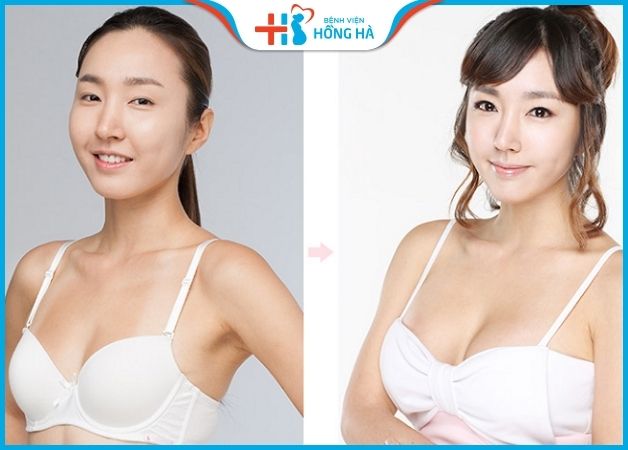 Khách hàng hài lòng về dịch vụ nâng ngực đẹp, an toàn tại BV Hồng Hà