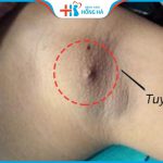 Cắt tuyến vú phụ: Ai nên và không nên cắt