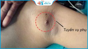 Cắt tuyến vú phụ: Ai nên và không nên cắt