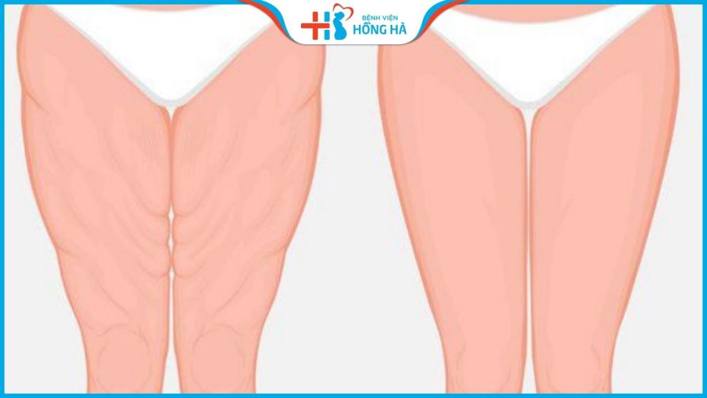 Hút mỡ đùi có nguy hiểm không? Giảm ở đâu tốt, uy tín, an toàn
