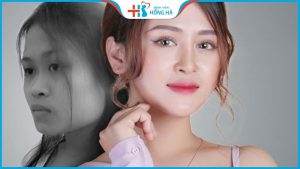Phẫu thuật Nâng gò má tạo gương mặt đẹp tự nhiên, không góc chết