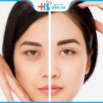 Nâng cung mày: Giải pháp trẻ hóa, làm đẹp hiệu quả khách hàng tuổi 40
