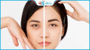 Nâng cung mày: Giải pháp trẻ hóa, làm đẹp hiệu quả khách hàng tuổi 40