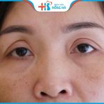 Chỉnh sửa mí mắt hỏng, Trợn, Sâu, sau phẫu thuật- Những điều cần biết