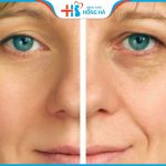 Xóa rãnh lệ: Giải pháp trẻ hóa đôi mắt, trở lại 15 năm tuổi xuân
