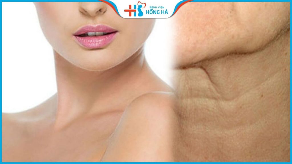 Căng da cổ nội soi giá bao nhiêu? Bí quyết xóa 90% nếp nhăn vùng cổ