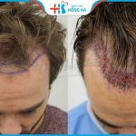 Hạ đường chân tóc có nguy hiểm không? Giá bao nhiêu?