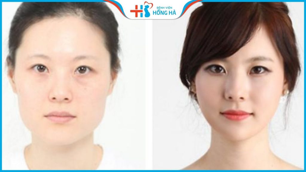 Gọt hàm V line đẹp tự nhiên, an toàn tại Thẩm mỹ Bệnh viện Hồng Hà