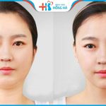 8 Cách giảm mỡ mặt và nọng cằm hiệu quả ngay tại nhà