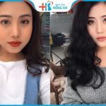 Trượt cằm là gì? Có đau và nguy hiểm không? Sau bao lâu thì lành?