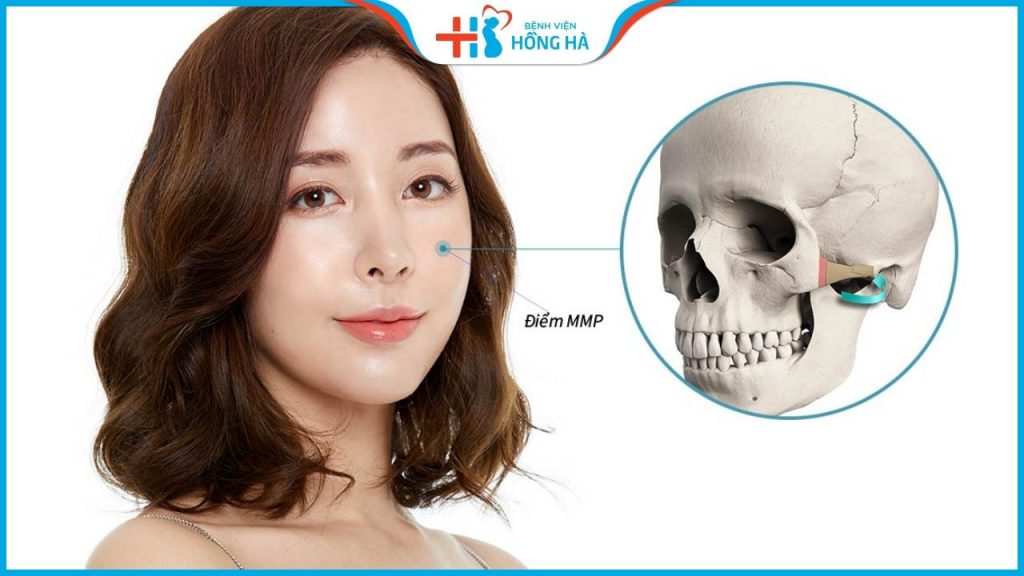 Hạ gò má cao là gì? Có đau và nguy hiểm không?