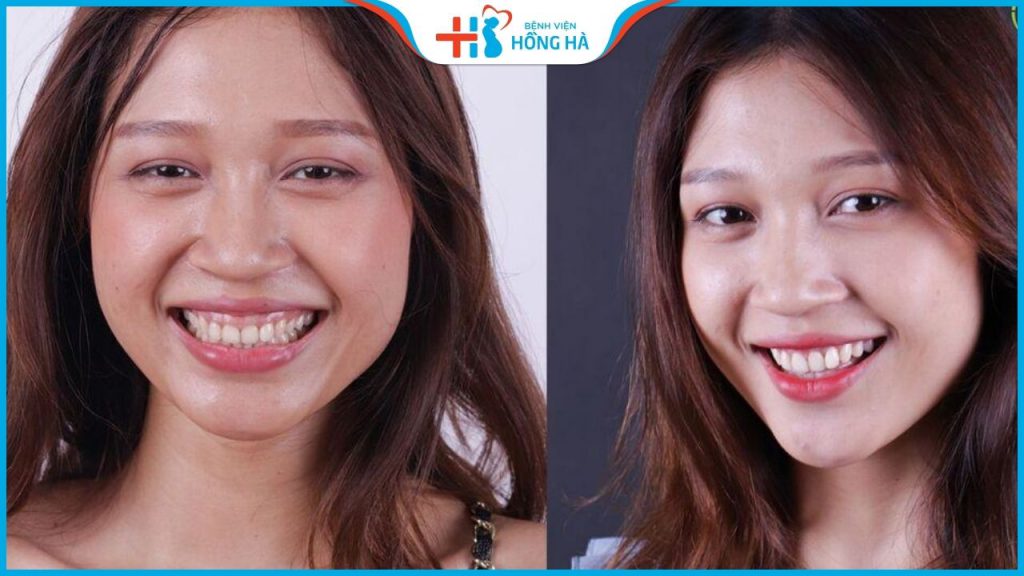 Phẫu thuật Thẩm Mỹ Hết cười hở lợi, trả lại nụ cười xinh