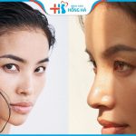 Tạo cằm chẻ: Xu hướng phẫu thuật tạo hình cằm chẻ vượng cát, tài lộc