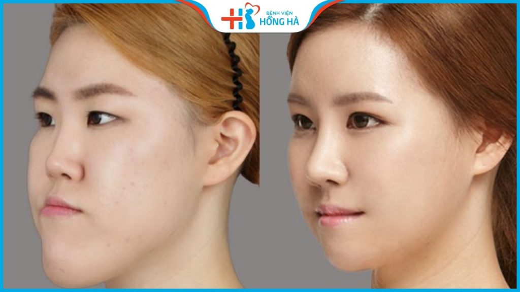 Chỉnh hình hàm hô móm đau không? Giá bao nhiêu? Quy trình thực hiện?