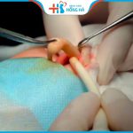 Vì sao phải tháo/Rút chất liệu mũi? Ưu điểm thực hiện Thẩm mỹ Bệnh viện Hồng Hà