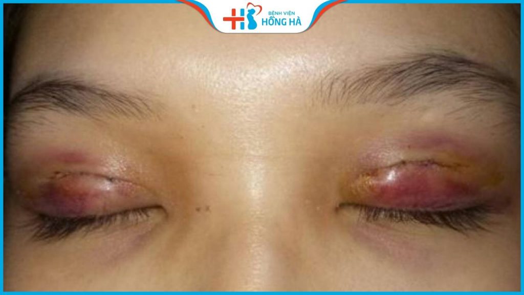 Cắt mí hỏng, sâu, trợn, không đều và cách khắc phục hiệu quả 100%