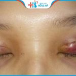 Cắt mí hỏng, sâu, trợn, không đều và cách khắc phục hiệu quả 100%