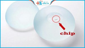 Nâng ngực túi Motiva chip có tốt không? Bảng size túi ngực chi tiết