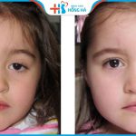 Chỉnh hình sụp mí bẩm sinh: Cấp độ 1-4 và Cách chữa hiệu quả