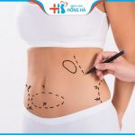 Hút mỡ xong có béo lại không? Cách duy trì giảm mỡ tốt nhất