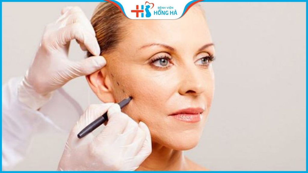 Căng da thái dương: Bí quyết trẻ hóa gương mặt hiệu quả
